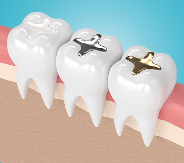 Grayslake Composite Fillings