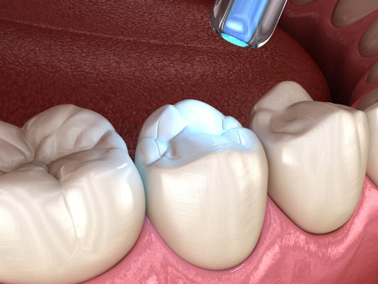Dental Filling Grayslake, IL