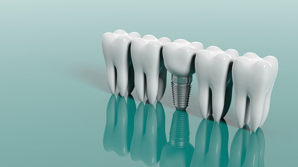 Does Oral Hygiene Change After Getting Dental Implants?