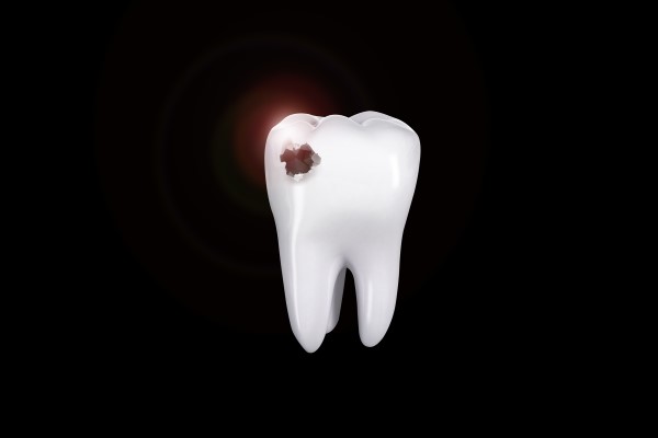 Cavity Treatment: Three Reasons Not To Put It Off