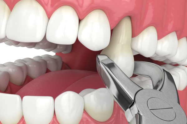Tips For Tooth Extraction Aftercare