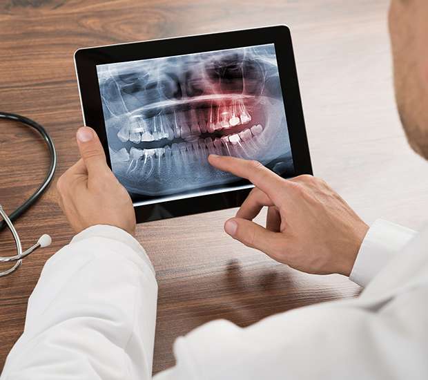 Grayslake Types of Dental Root Fractures